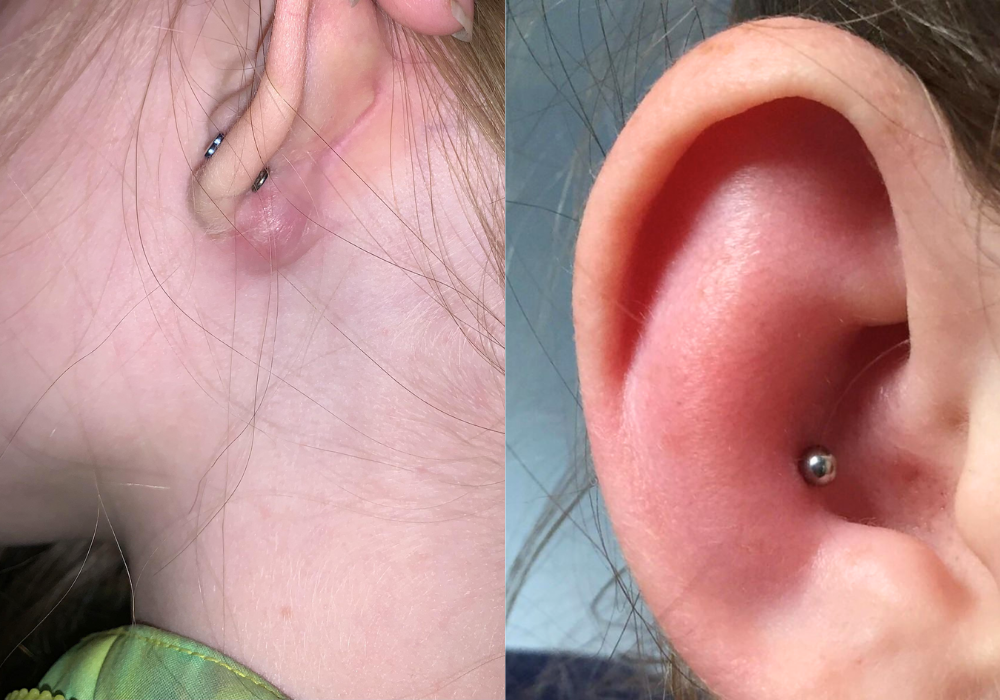 Bấm lỗ tai có đau không? Bấm lỗ tai bao lâu thì lành? 5 Cơ địa ảnh hưởng nhiều đến thời gian lành